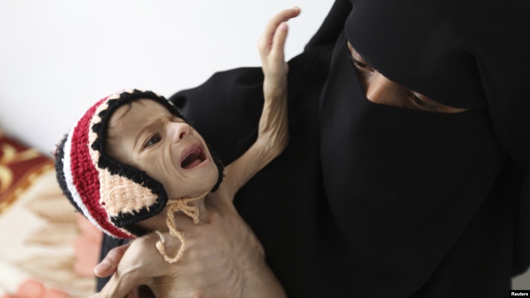 FILE - A woman holds her malnourished child at a feeding center at al-Sabyeen hospital in Yemen's capital, Sana'a.