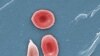 A colorized microcsope image made available by the Sickle Cell Foundation of Georgia via CDC.