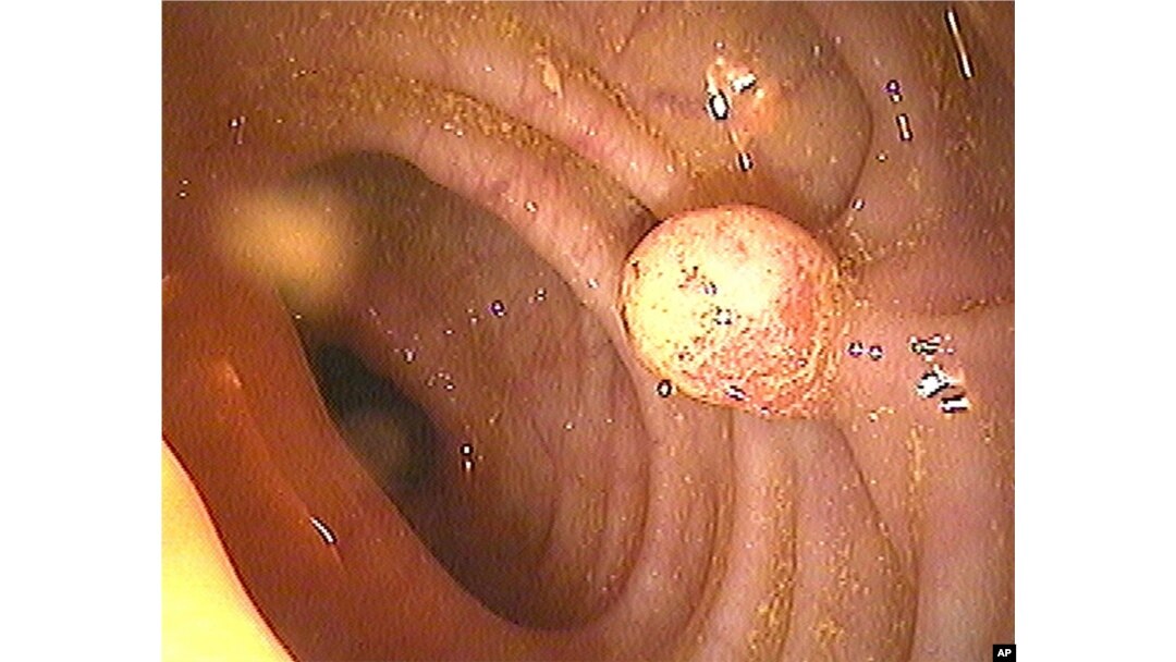 Colon Cancer Test