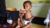 FILE - A Yemeni woman feeds a malnourished child at a clinic in the war-ravaged western province of Hodeidah, Aug. 7, 2021.