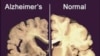Exercise Could Stem Alzheimer's Onset