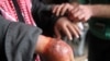 FILE - A man with a hand showing symptoms of leishmaniasis waits to be treated at a hospital in Aleppo, Syria, Feb. 11, 2013.